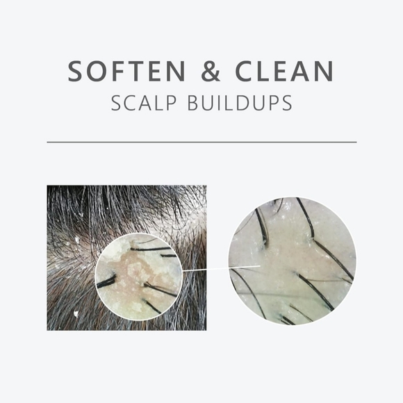 Purifying Liquid Shampoo Exfoliator For Dandruff, Psoriasis, Dermatitis, Dry ... - Picture 6 of 6